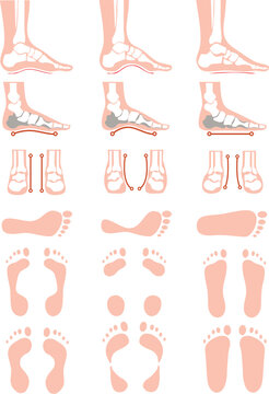 Foot pathologies infographic. foot anatomy. Deformed