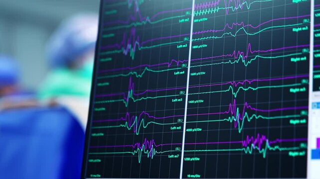 Green and purple curved lines on the monitor of computer. Work of brain under surgery. Close up. Medic works at backdrop in blur.