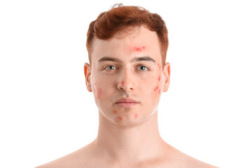Obraz premium Teenage boy with acne on white background