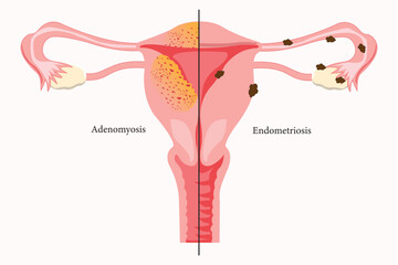 illustration comparison of adenomyosis and endometriosis. eps 10. medical illustration