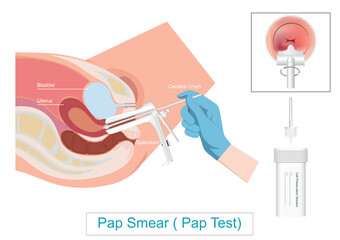 Pap Test ( Pap Smear ) Cervical Cancer Screening.