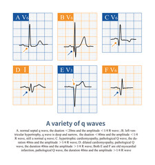 The classic pathological Q wave refers to a Q wave duration more than 40ms, with an amplitude greater than 25% R wave amplitude, commonly seen in cardiomyopathy and myocardial infarction.