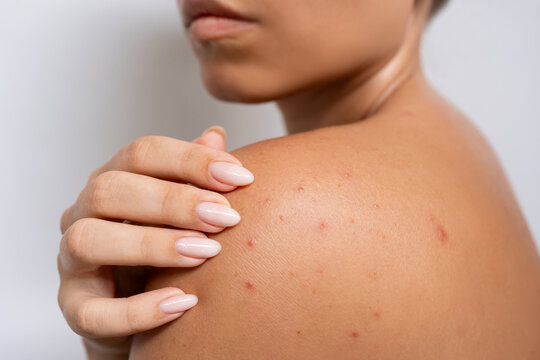 Close-up of a red rash on the shoulder. Young woman touching her back with acne problem. Allergies, pimples, hormonal changes. Problem skin, sweating sickness, prickly heat. Dermatology concept