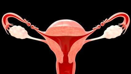 An oophorectomy is a surgical procedure to remove one or both ovaries. It's usually performed to treat ovarian cancer or other ovarian issues.