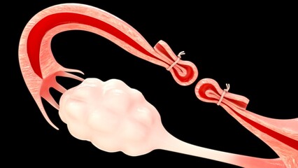 tubectomy of fallopian tube 3d illustration