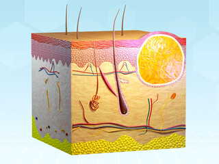 Sebaceous cyst in human skin