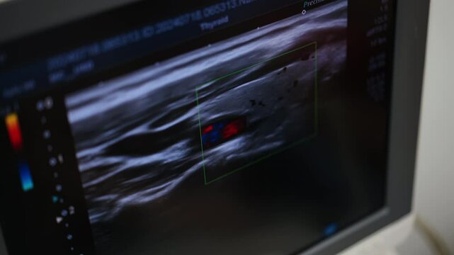 Ultrasound scanning of thyroid on the monitor of medical machine. High angle view at the screen of ultrasonic equipment.