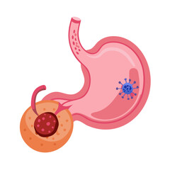Stomach Cancer and Cancer Attacking Cells Vector Illustration
