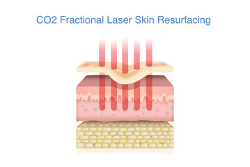 Skin layer with  acne scar treated by CO2 fractional laser into middle layer. 3D illustration about technology for healing scars and reduce wrinkles.