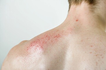 Fototapeta premium Close-up of sunburned skin exhibiting redness, irritation, and inflammation on a man's back, highlighting the damaging effects of excessive sun exposure