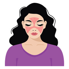 Red Systemic Lupus Erythematosus Young woman with the typical butterfly rash in lupus Illustration