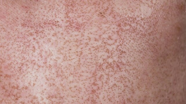close up burned from co2 laser treatment face after procedure