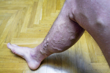 Varicose veins. Phlebology and DVT. Varicose veins on leg of man. Varicosity on legs, spider veins,...