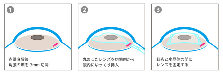 ICL手術の工程図解-日本語-