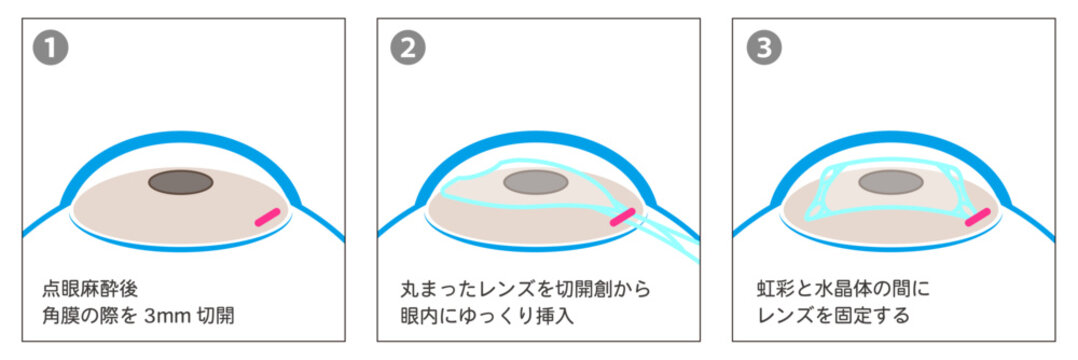 ICL手術の工程図解-日本語-
