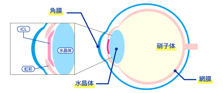 ICL手術の解剖学的図解-日本語-