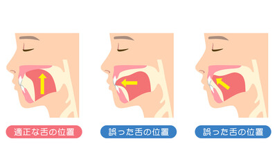 適正な舌の位置と誤った舌の位置　ミューイング © koti