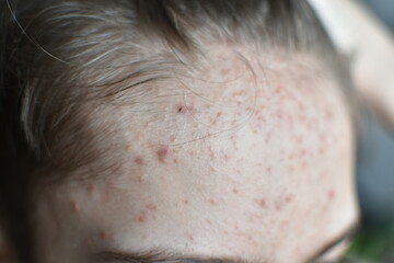 Fototapeta premium close-up of acne on the face of a teenage boy. dermatological skin problems. professional skin care