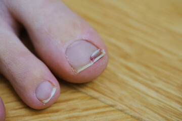 big toe with nail injury. The edges of the nail are slightly cracked, a small cut with a drop of blood is visible on one side. The background is a wooden surface.