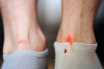 rubbed male heels. bloody calluses from uncomfortable shoes. the correct selection of shoes, a remedy for calluses, ways to stretch shoes.