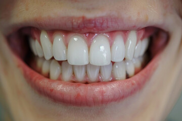 Fototapeta premium Close-up of a woman's smile showing healthy white teeth.