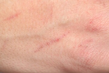 Texture of skin with scratches as background, closeup