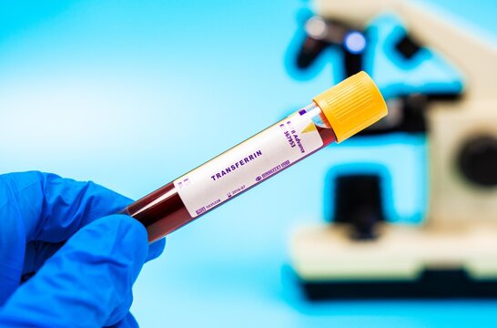 Iron transport marker Measures transferrin levels, affected in cancers with iron metabolism changes, used for monitoring treatment.