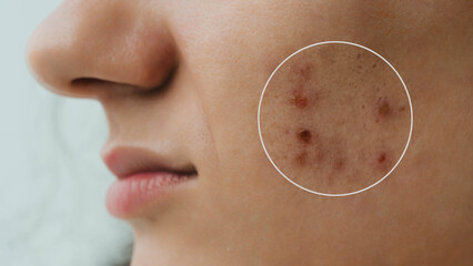 Close-up of a young girl with skin problems. Pimples, acne, pores, scars. Natural skin with and...