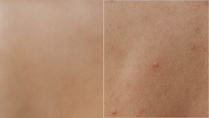 Close-up of a woman's back skin before and after treatment for acne and other dermatological problems.