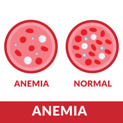 Anemia disease. The difference of Normal red blood cell and Anemia