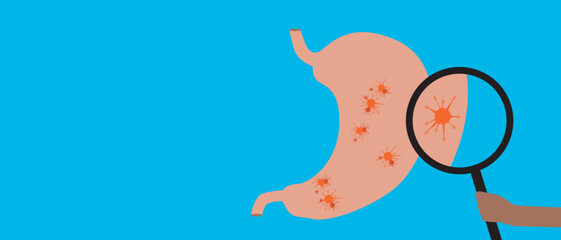 Stomach with malignant tumor as oncology concept, flat vector stock illustration or copy space template with stomach cancer