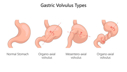 gastric volvulus types, normal stomach, organo-axial volvulus, mesentero-axial volvulus with rotational axes diagram hand drawn schematic vector illustration. Medical science educational illustration