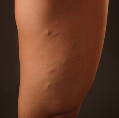 Fototapeta premium Beautiful slender woman shows varicose veins on the legs. Treatment of varicose veins and capillaries.