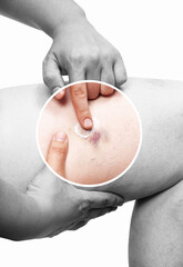 Removal of varicose veins on the legs. Medical inspection and treatment of Telangiectasia....