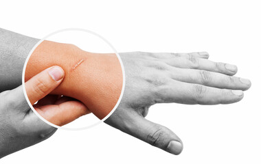 Large scar on human body close-up. Skin scar removal.