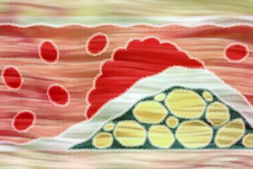 Arteriosclerosis is a common vascular disease in which the arteries become narrowed and hardened by deposits such as fats