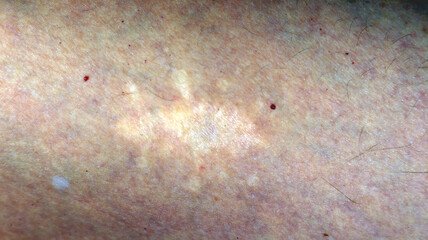 Human skin texture revealing an old scar with visible variations in color and texture under natural light conditions