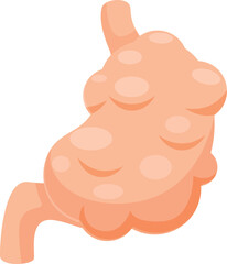 Diseased stomach with multiple polyps growing inside, representing a serious medical condition requiring urgent attention