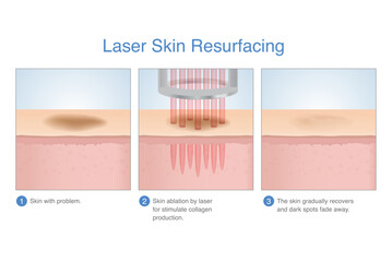 Laser skin resurfacing in 3 Step3. Skin with dark spots, freckles and scar on surface faded after treating with laser energy deep in the skin layer.