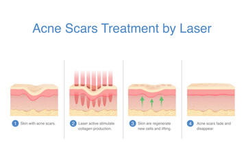 Acne scars treatment by laser. Laser active stimulate collagen, regenerate and lift from under the skin layer. Make acne scars and holes fade and disappear.