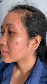 close up of a bare face with breakout face, acne prone skin texture.