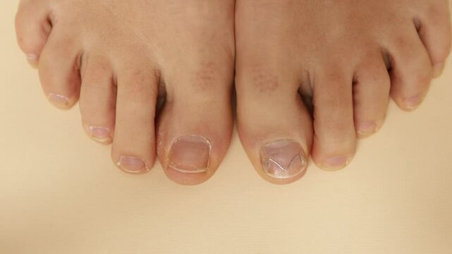 2 feet, view from above, ingrown nail with podofix system. View from above, close-up