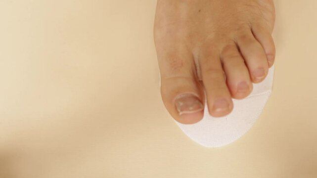 finger with ingrown nail with nail alignment system and foot in narrow sock. Top view, close-up. Concept of ingrown nail, onychocryptosis. Podofix correction systems