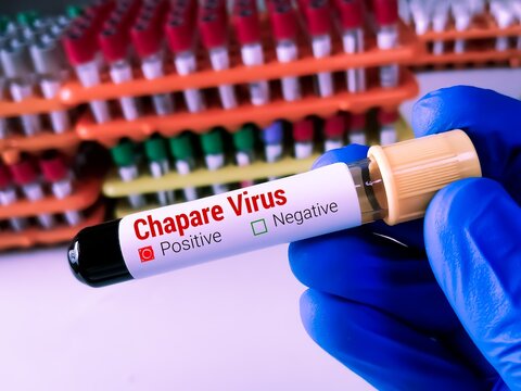 Blood sample for Chapare virus test at medical laboratory. Chapare mammarenavirus. Chapare hemorrhagic fever.