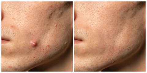 Fototapeta premium A side-by-side view of a man’s skin, comparing nodular acne with clear skin