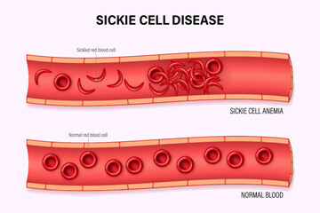 Sickle cell disease. Diagram of comparison Blood flow between sickle cell disease and normal blood vessels. Blood Disorder.