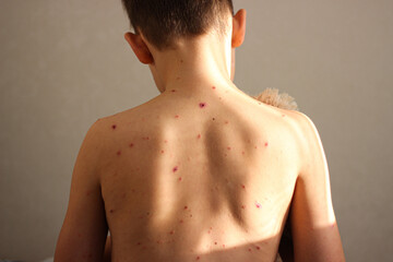 The child is sick with chickenpox. The boy has rashes all over his body, which are incredibly itchy...
