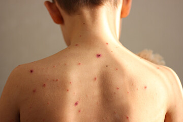 The child is sick with chickenpox. The boy has rashes all over his body, which are incredibly itchy...