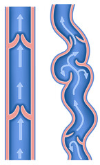 Schematic representation of varicose veins. We can see that they are dilated and tortuous veins, causing pain, swelling, and heaviness in the legs.