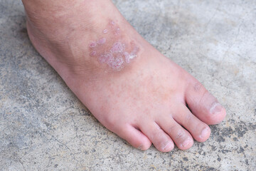 Scars on the skin of a man's feet are inflamed due to a fungal infection.